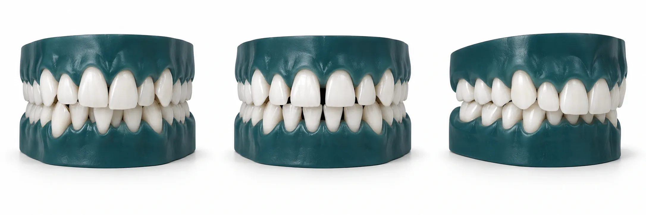 Ön dişlerde çapraşıklığı temsil eden 3D model
